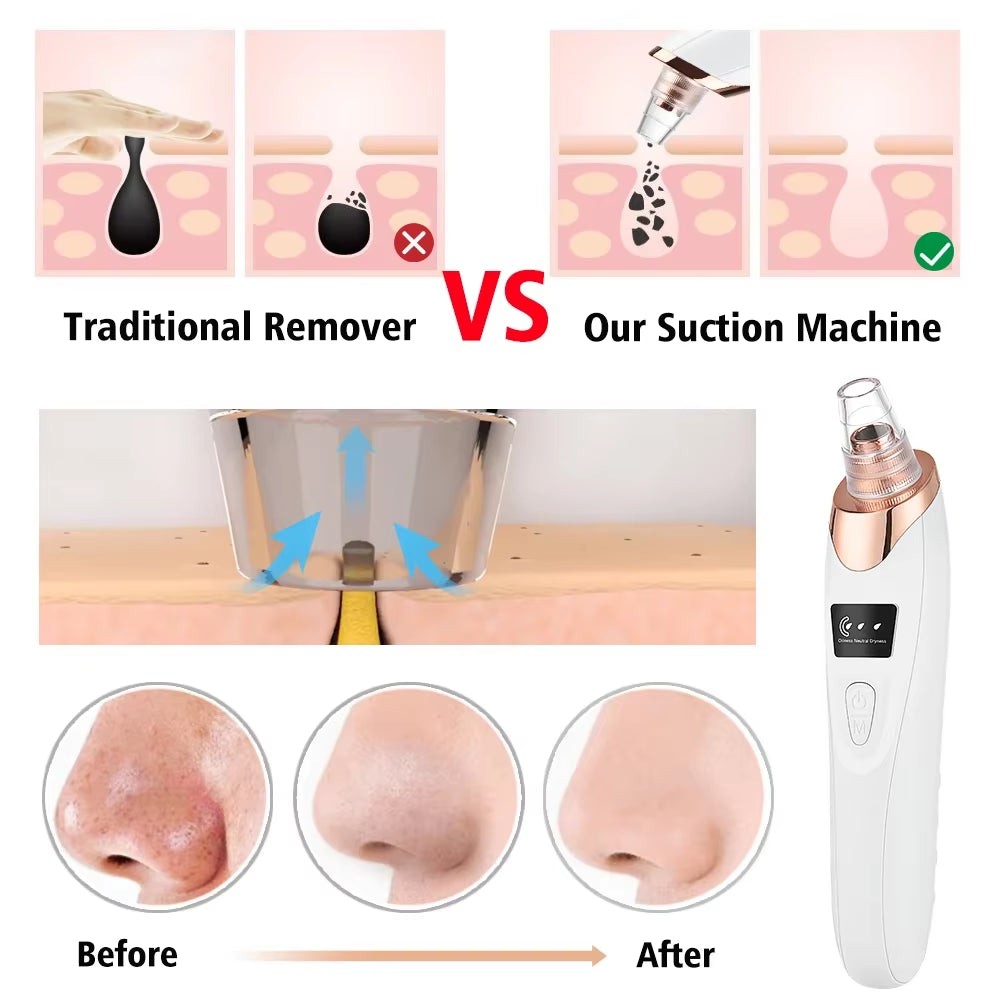 Revitalize Your Skin with Our Powerful Blackhead Remover Vacuum - Electric Face Cleaning Tool for Acne & Pore Perfection