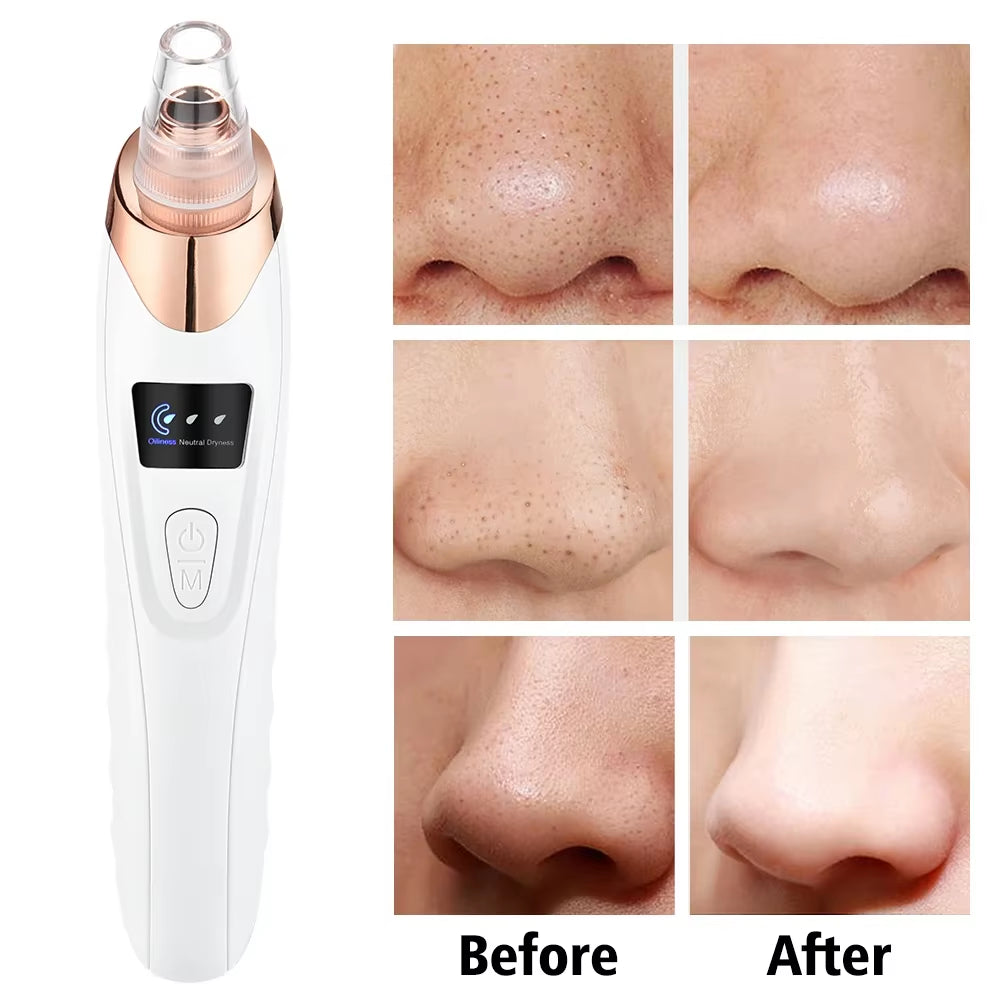 Revitalize Your Skin with Our Powerful Blackhead Remover Vacuum - Electric Face Cleaning Tool for Acne & Pore Perfection